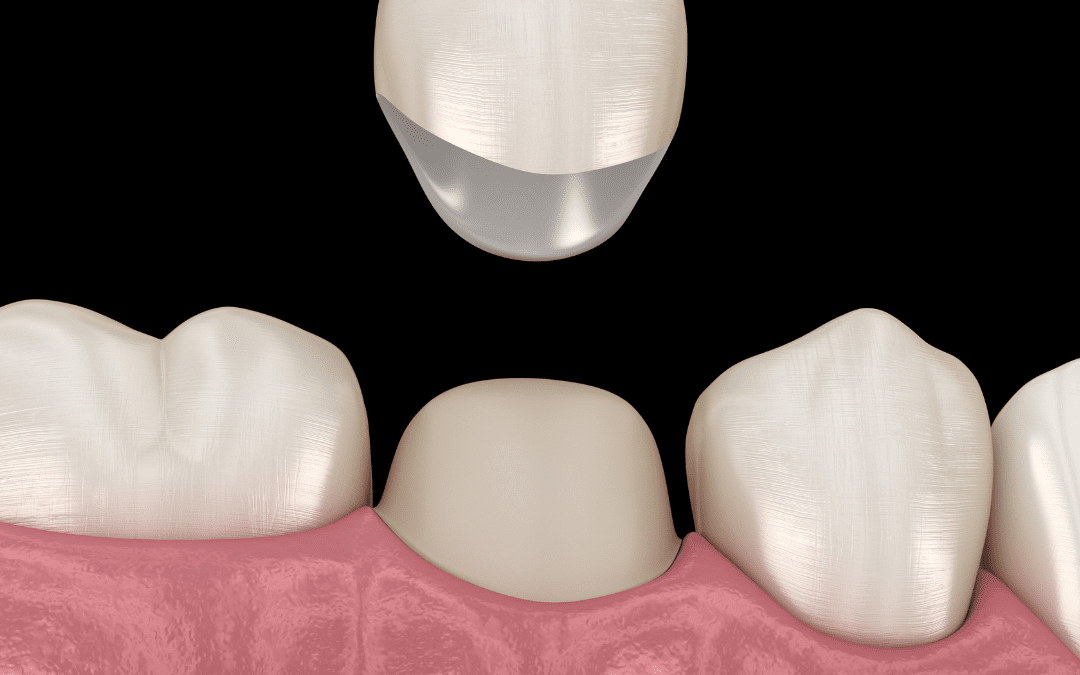 Benefits of a Dental Crown