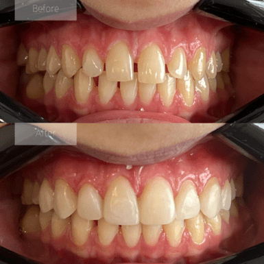 smile makeover with natural composite veneers