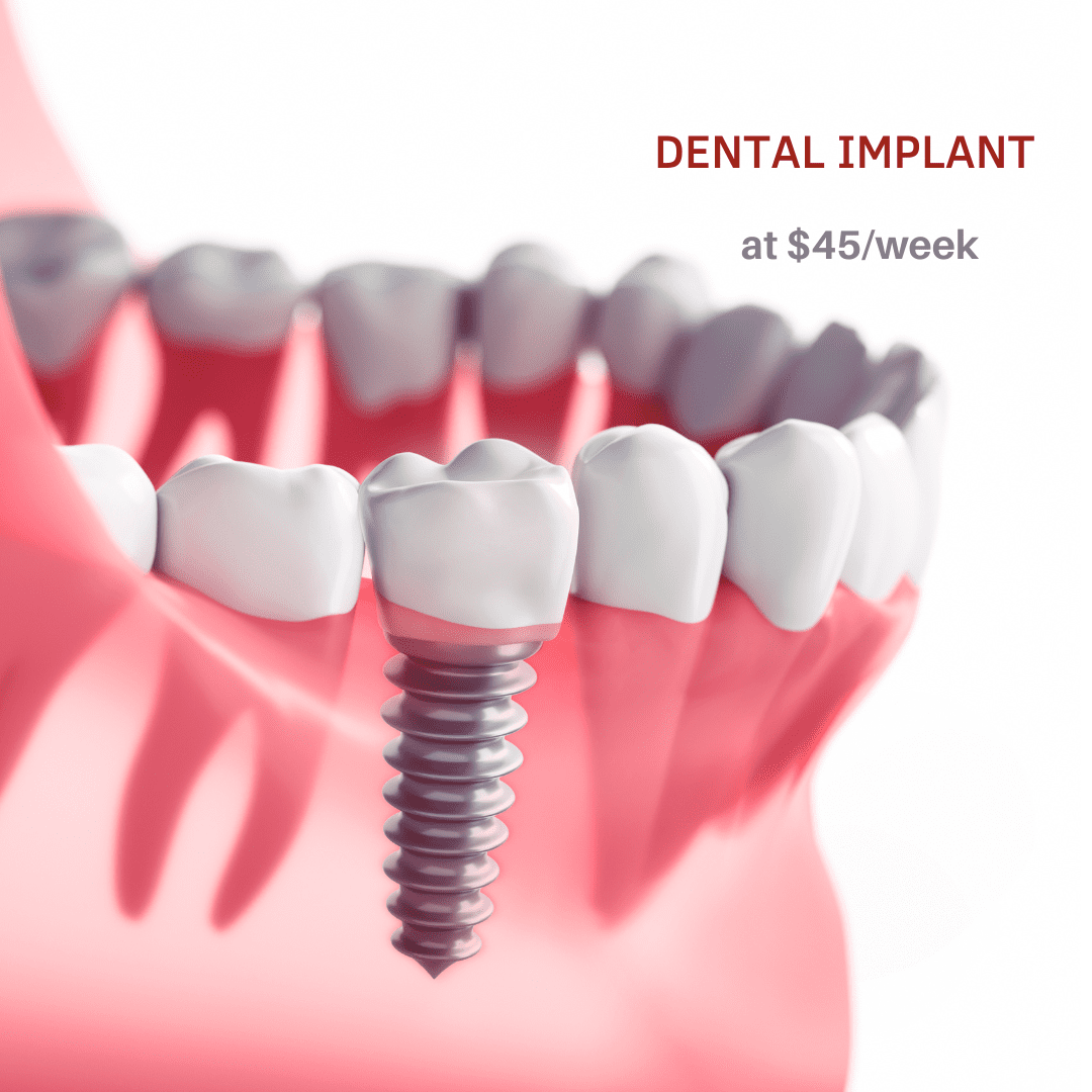 dental implants for just $45 per week