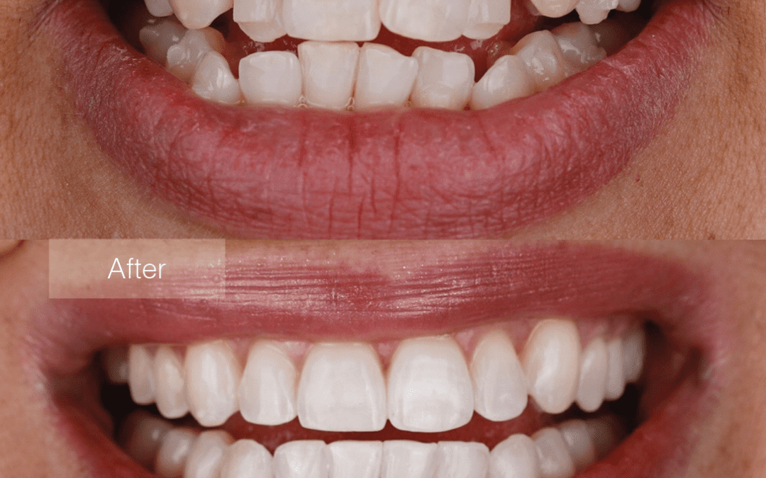 The Journey to a Perfect Smile with Invisalign in Kellyville