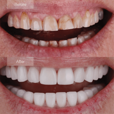 Smile makeover with porcelain veneers