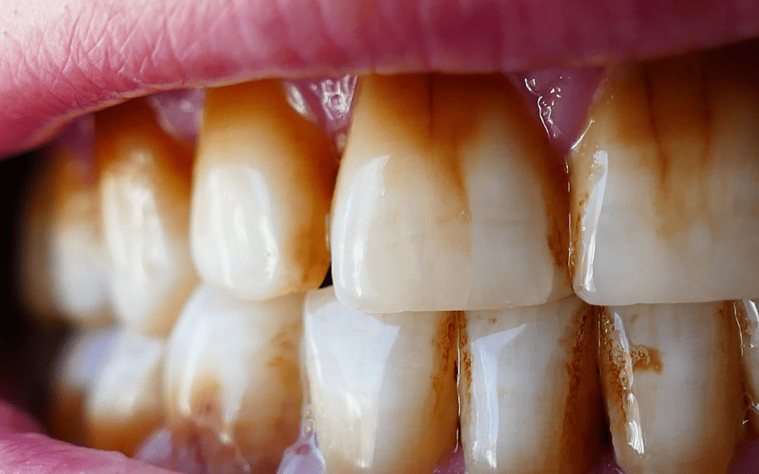 6 Habits That Can Stain Teeth!